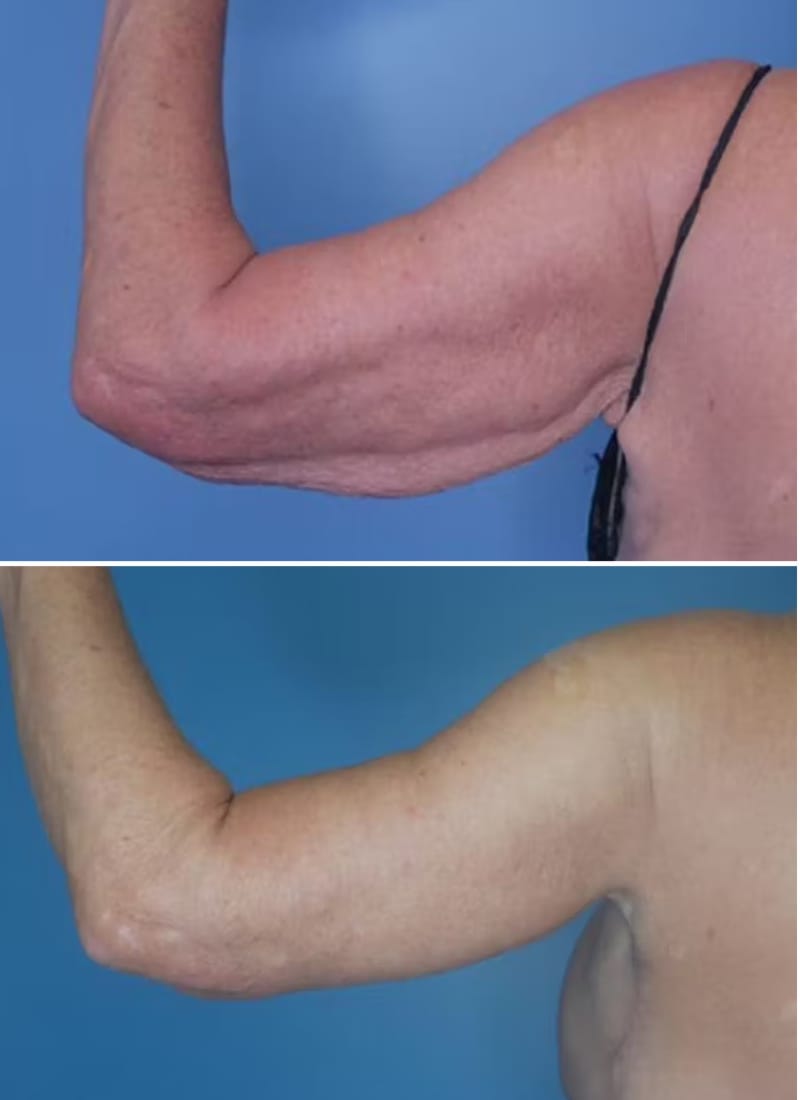 Before and After Image: Arm Lift (Brachioplasty) - back