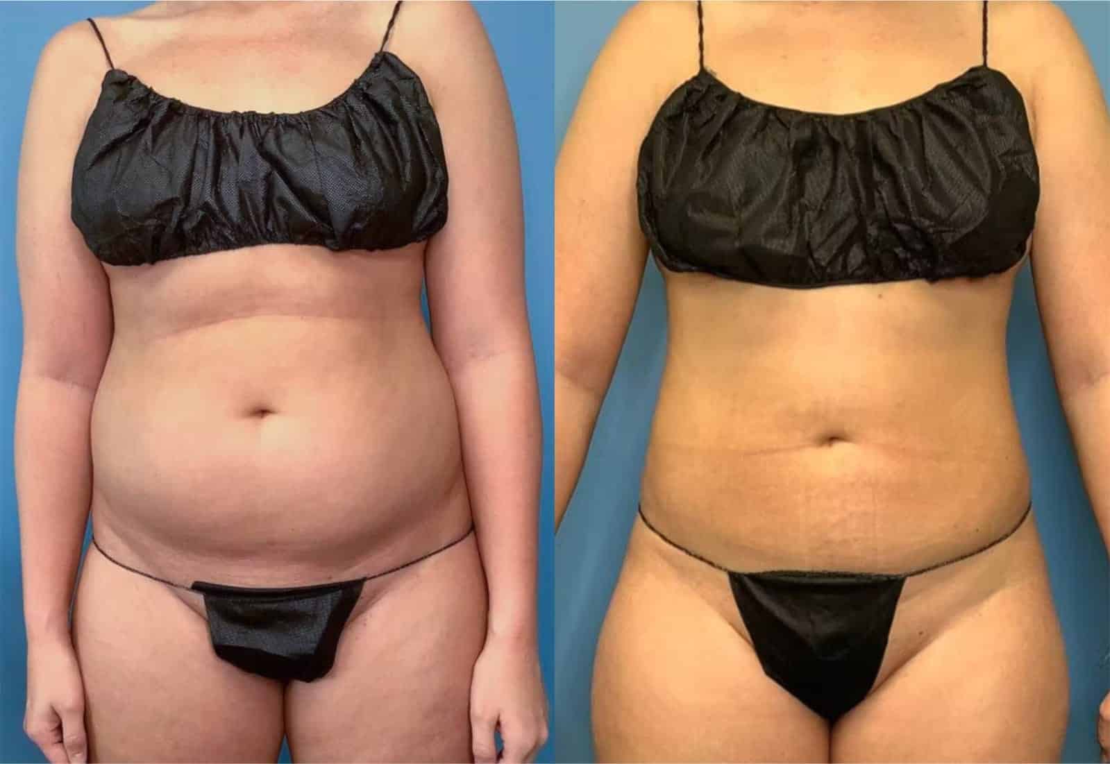 Before and After Image: Vaser Liposuction - front