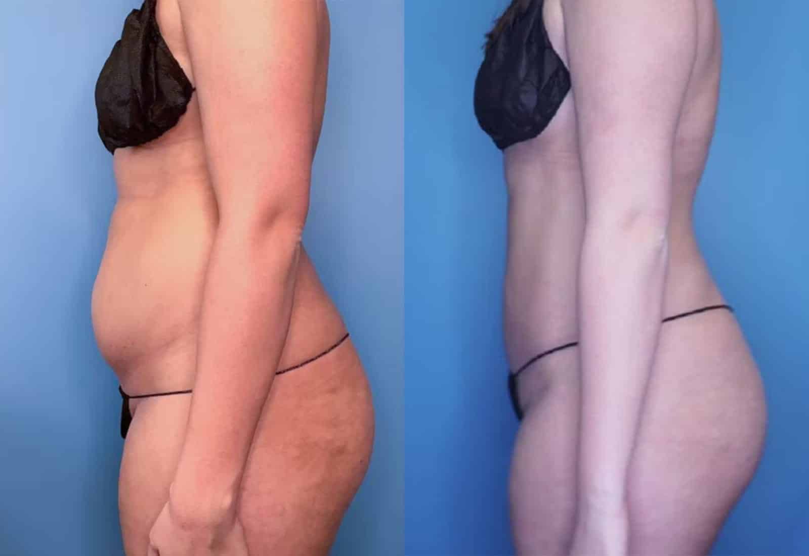 Before and After Image: Vaser Liposuction - left-side