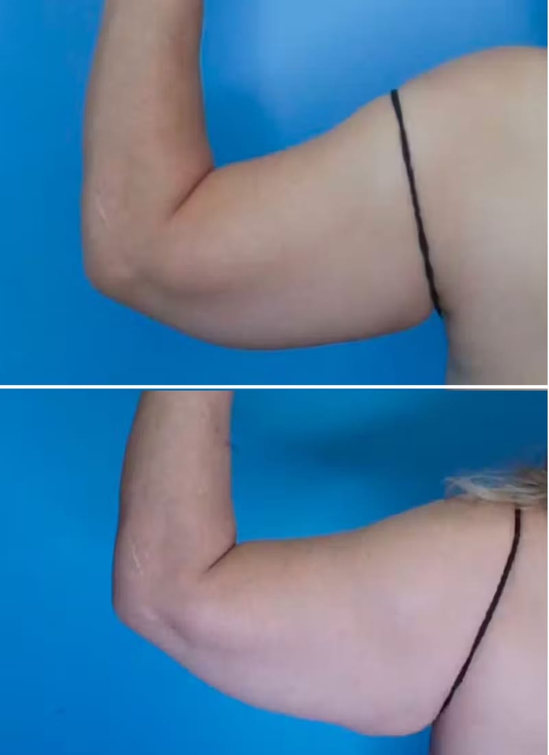 Before and After Image: Arm Lift (Brachioplasty) - back