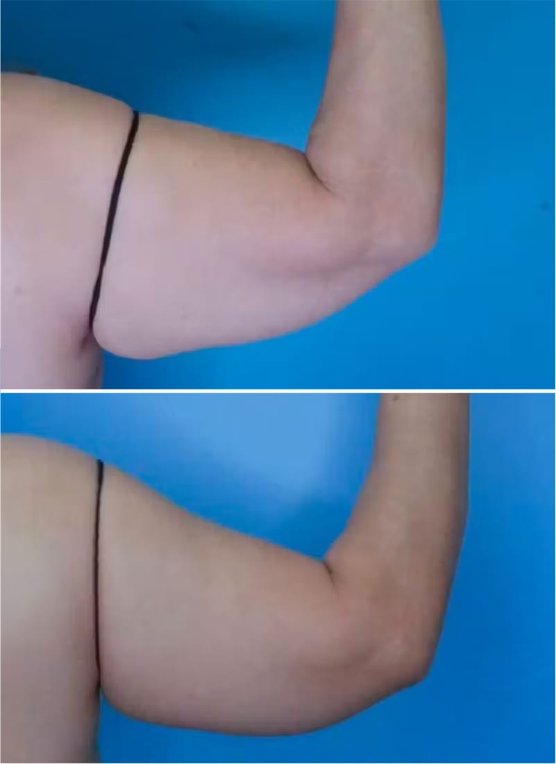 Before and After Image: Arm Lift (Brachioplasty) - back