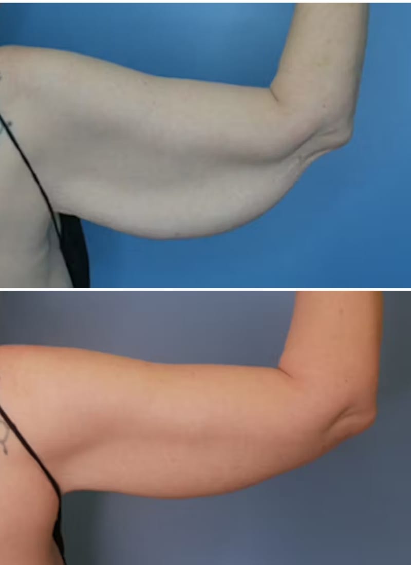 Before and After Image: Arm Lift (Brachioplasty) - back