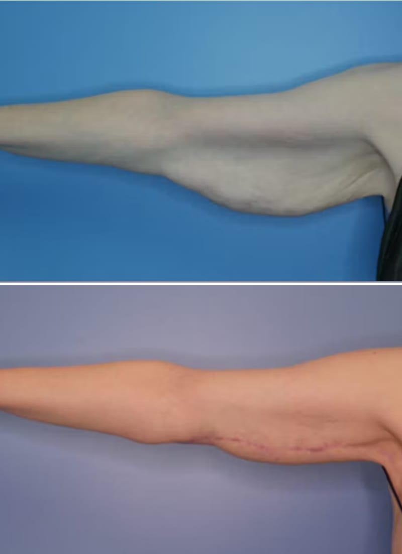 Before and After Image: Arm Lift (Brachioplasty) - front