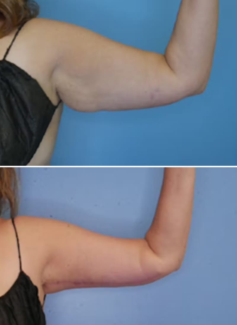 Before and After Image: Arm Lift (Brachioplasty) - front