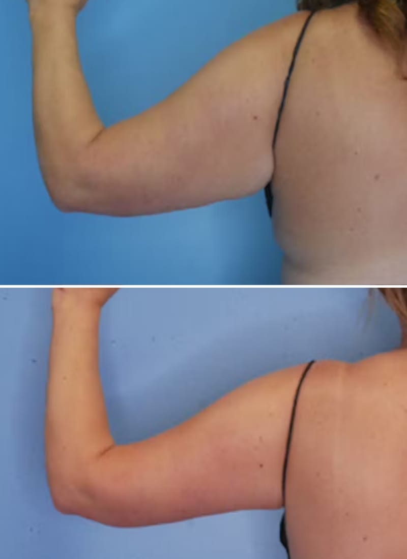 Before and After Image: Arm Lift (Brachioplasty) - back