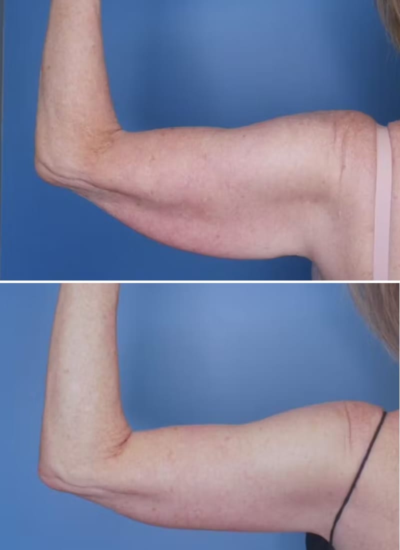 Before and After Image: Arm Lift (Brachioplasty) - back