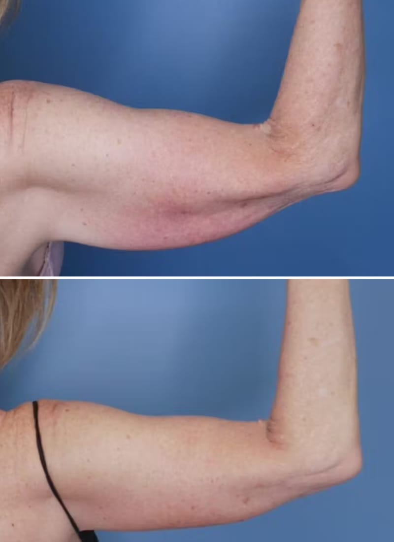 Before and After Image: Arm Lift (Brachioplasty) - back
