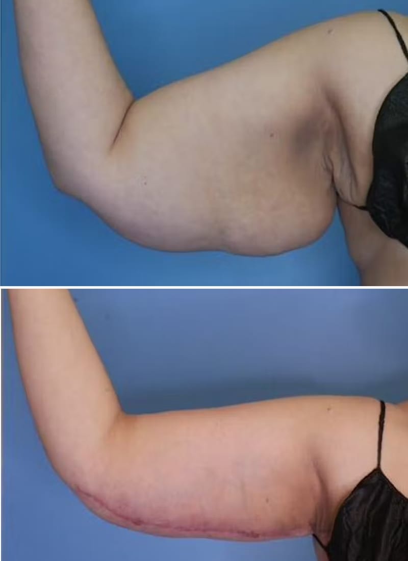 Before and After Image: Arm Lift (Brachioplasty) - back