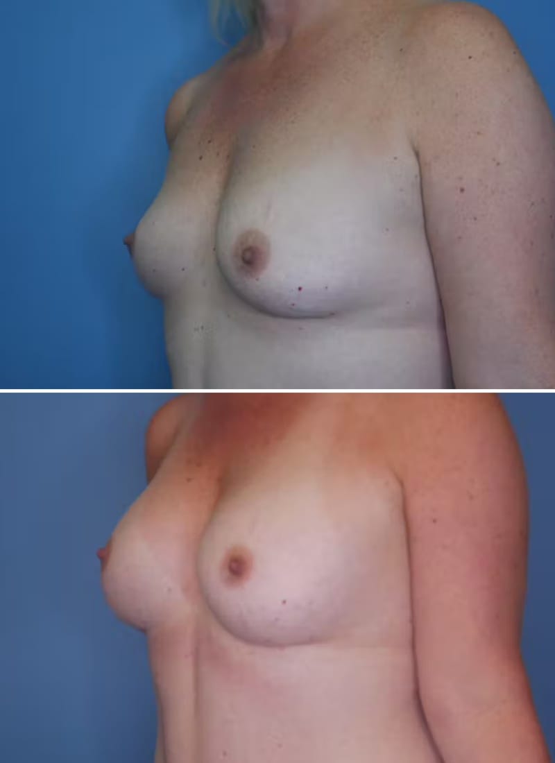 Before and After Image: Breast Augmentation - left-front-oblique