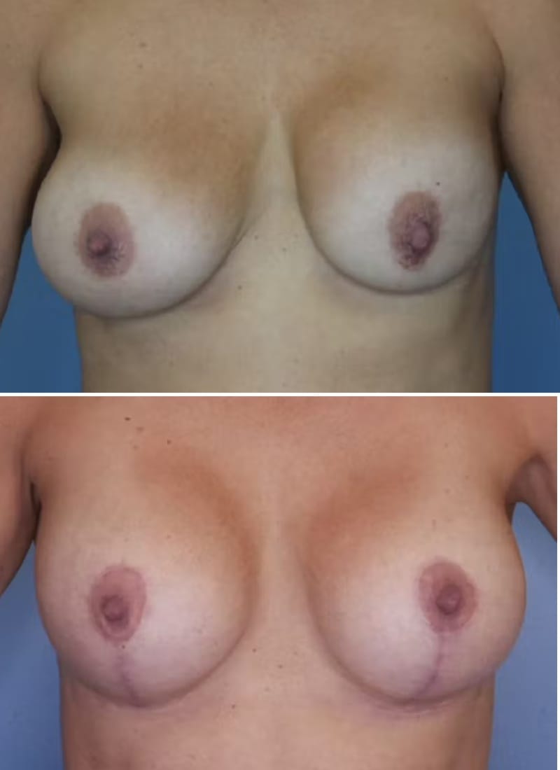 Before and After Image: Breast Augmentation - front