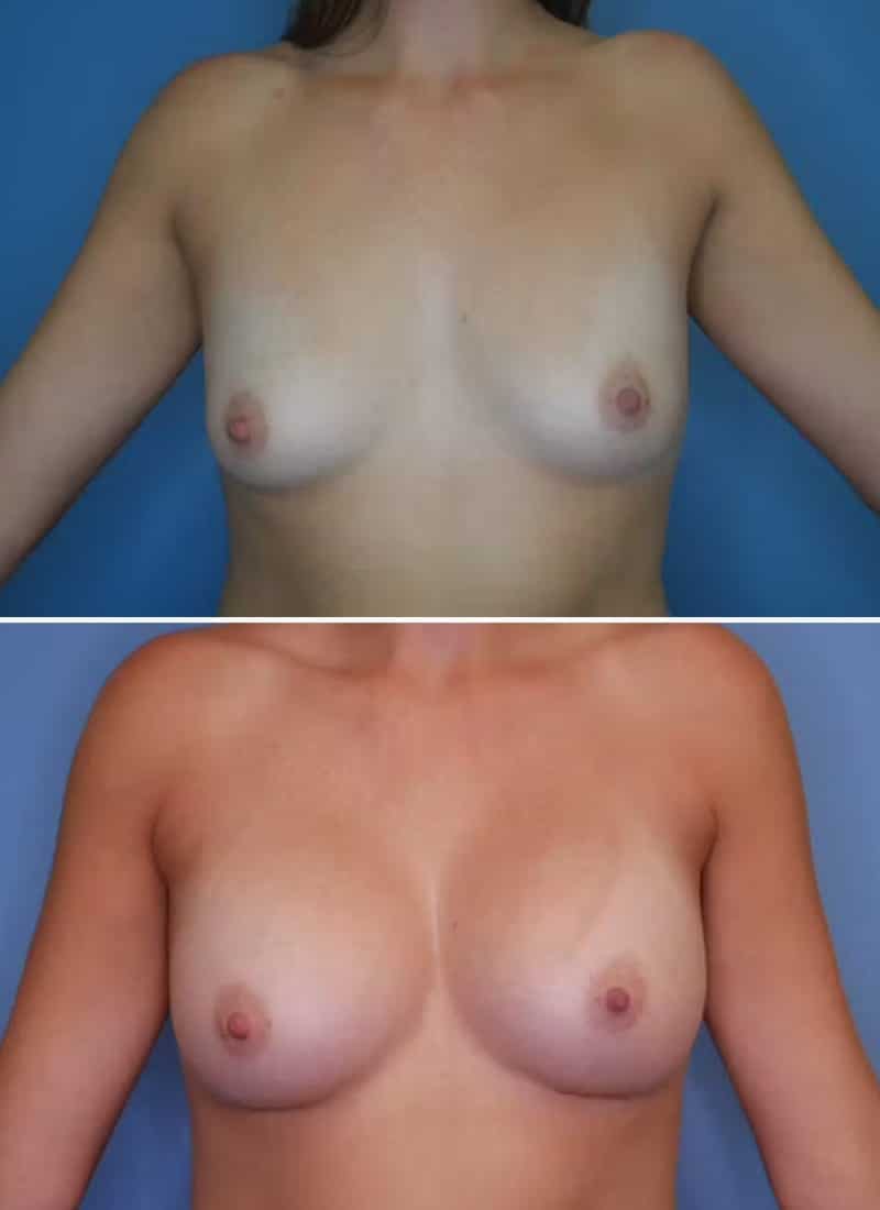 Before and After Image: Breast Augmentation - front