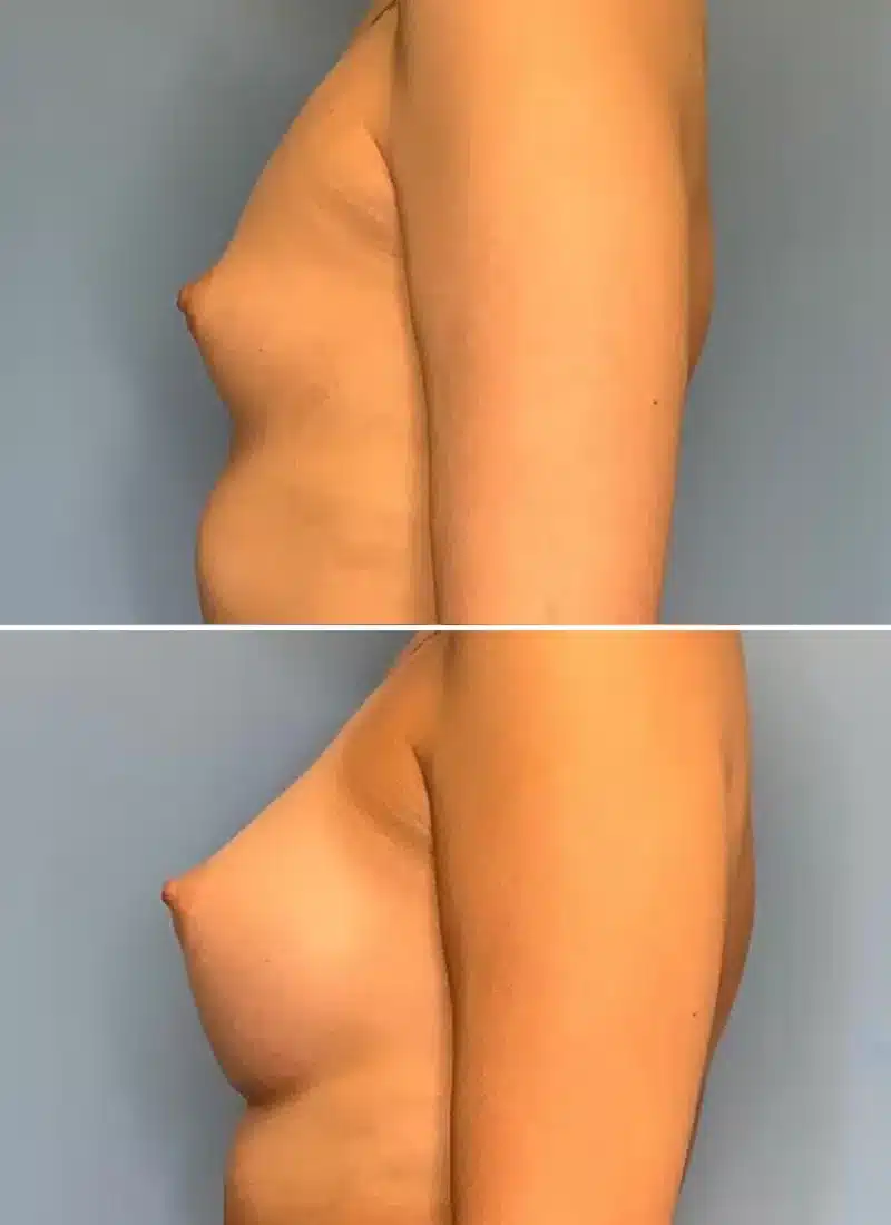 Before and After Image: Breast Augmentation - left-side
