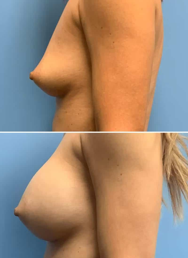 Before and After Image: Breast Augmentation - left-side