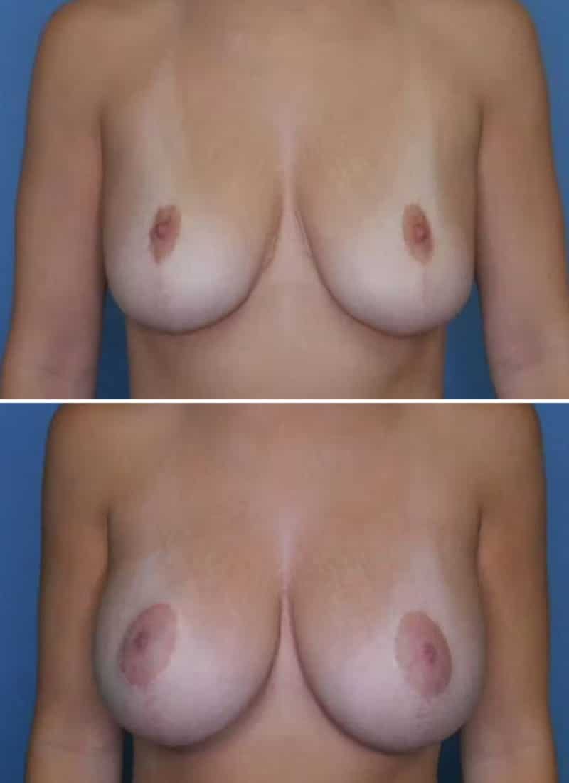 Before and After Image: Breast Augmentation - front