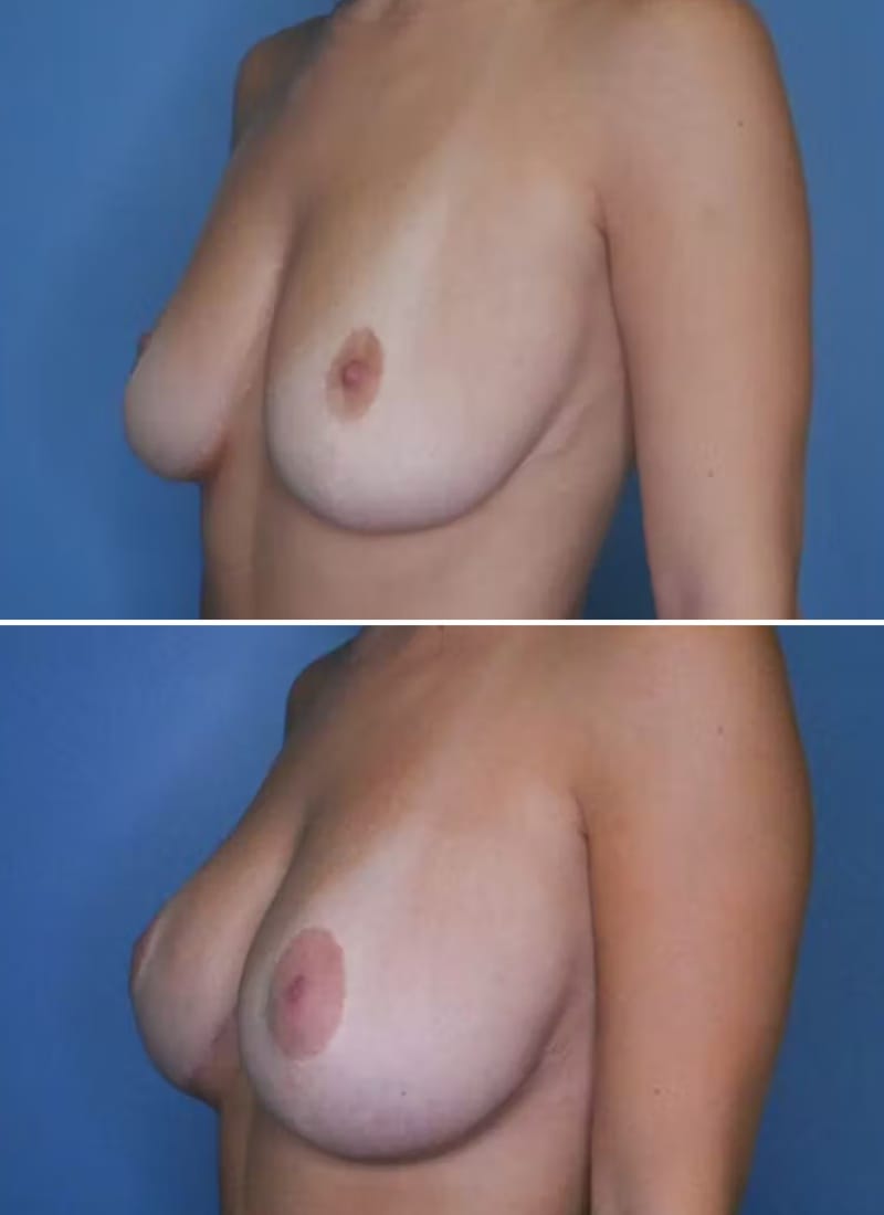 Before and After Image: Breast Augmentation - left-front-oblique