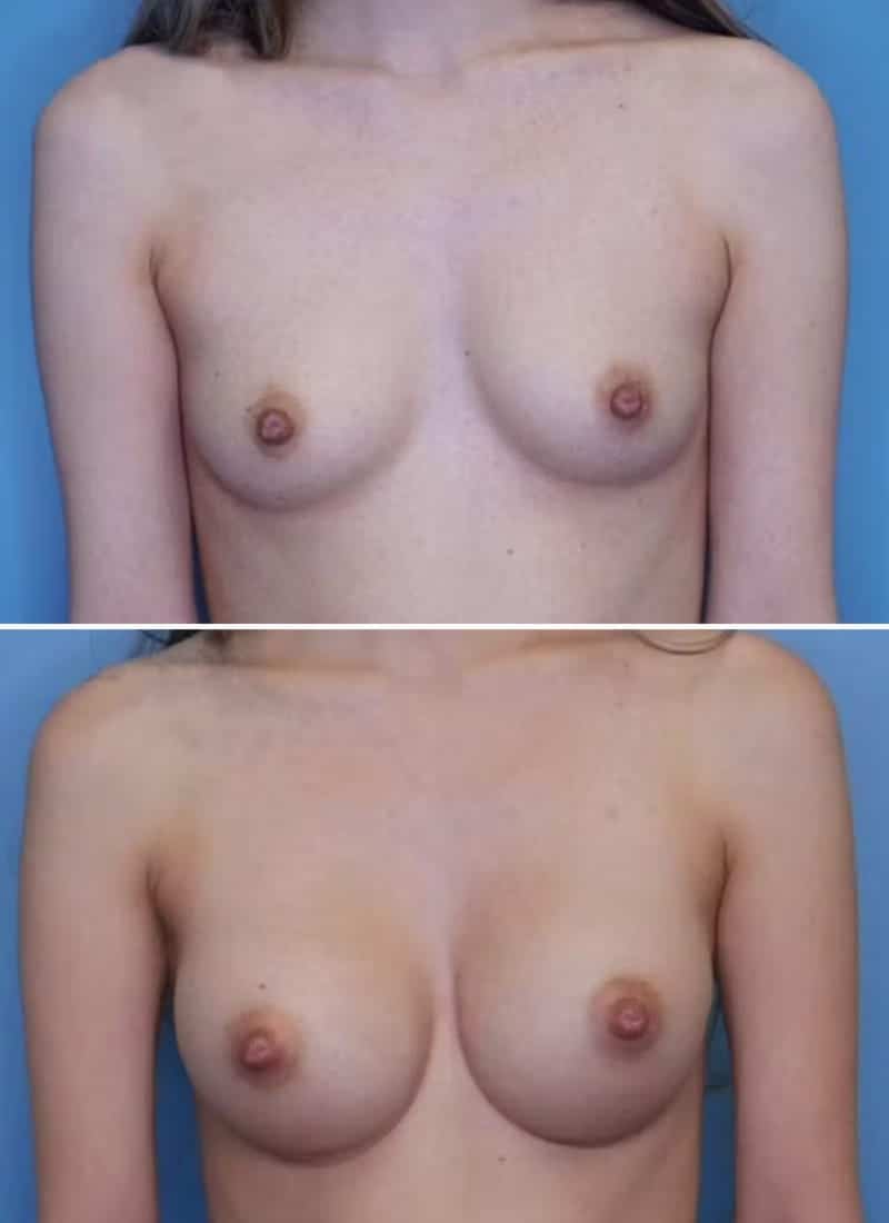 Before and After Image: Breast Augmentation - front