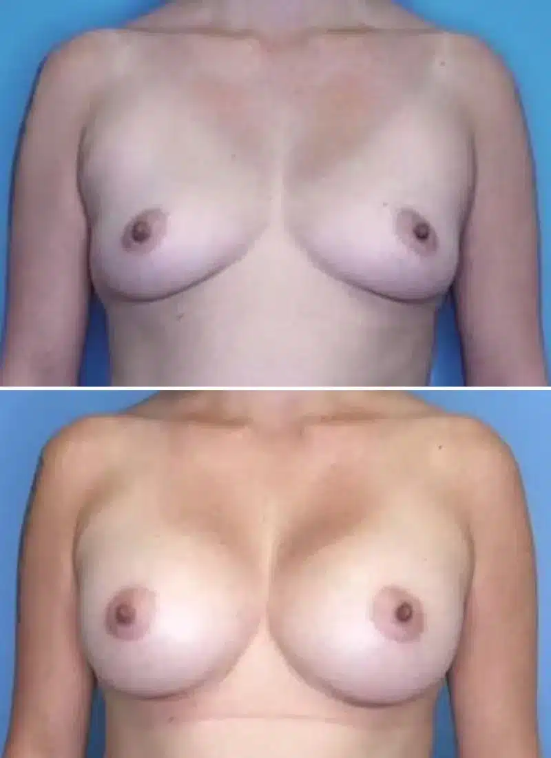 Before and After Image: Breast Augmentation - front