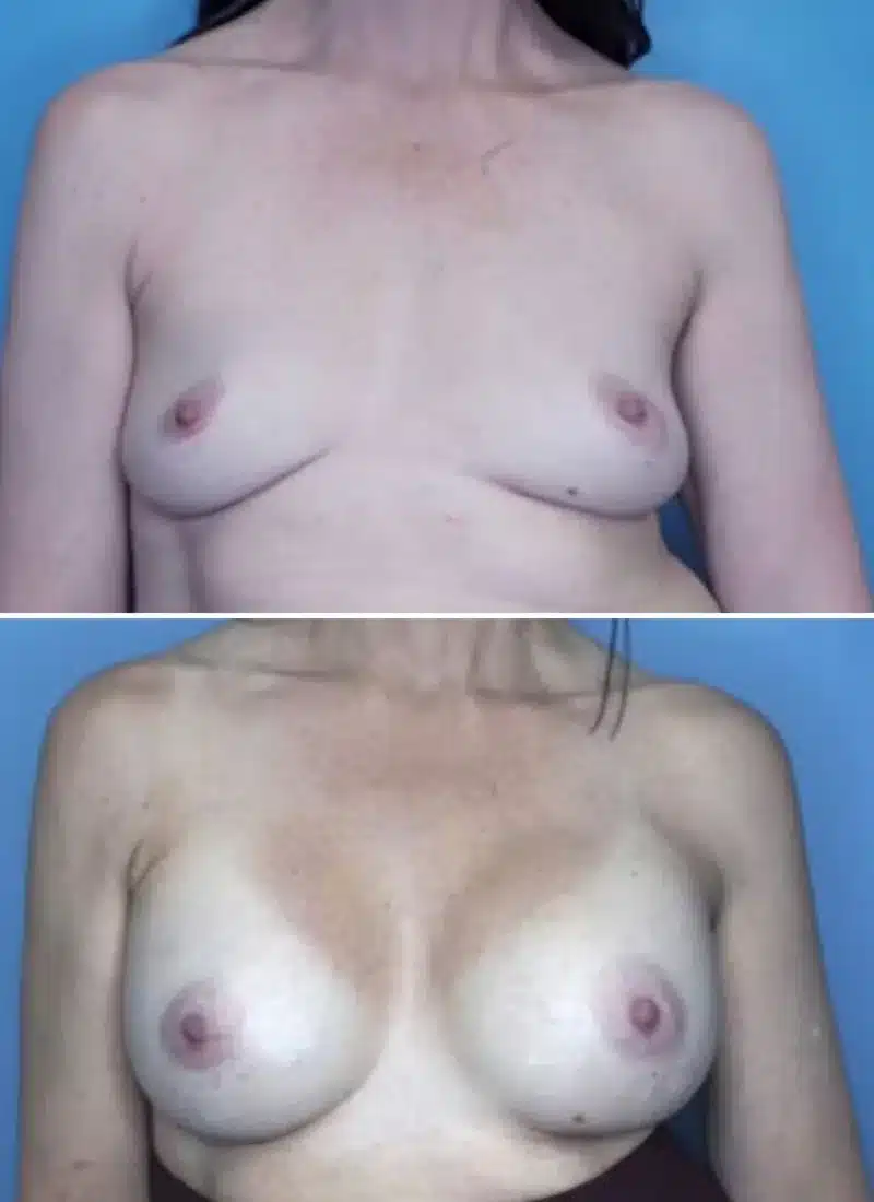 Before and After Image: Breast Augmentation - front