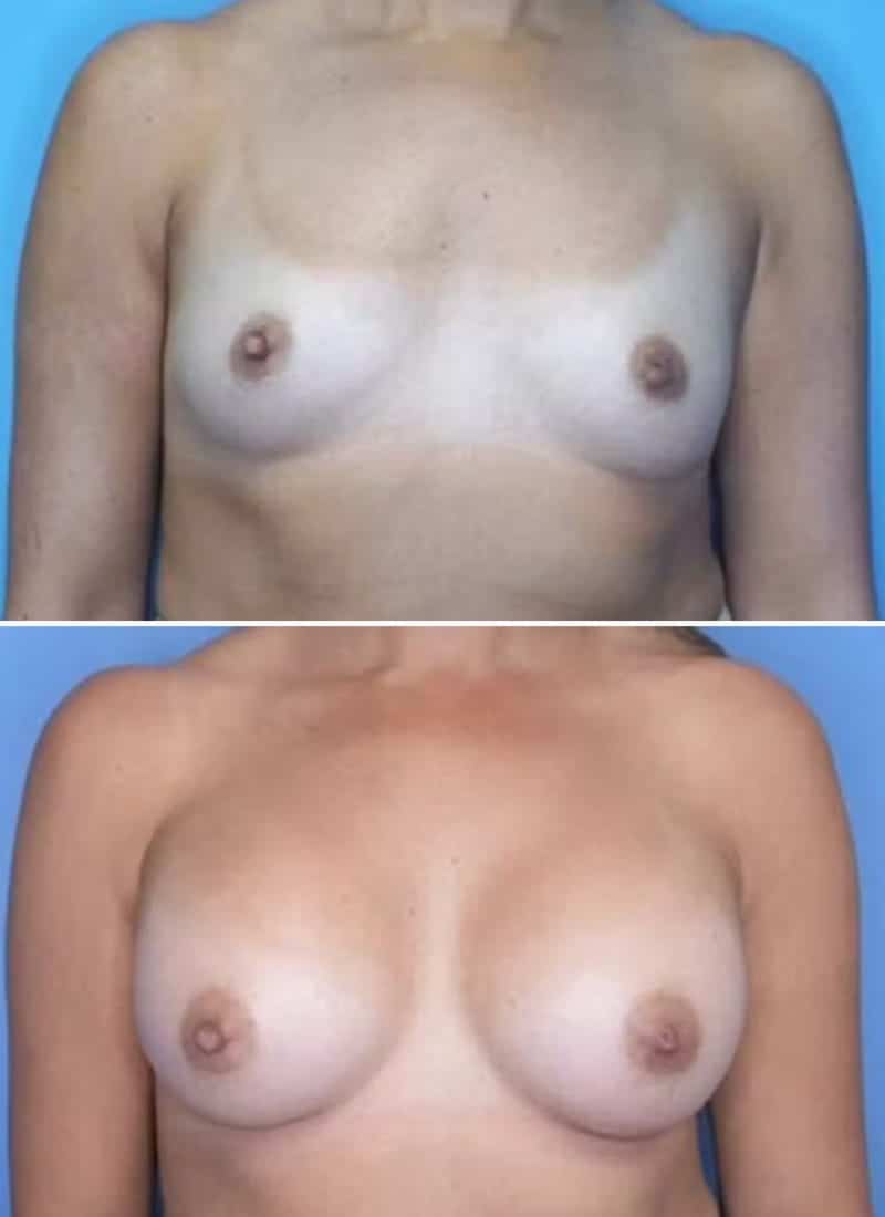 Before and After Image: Breast Augmentation - front