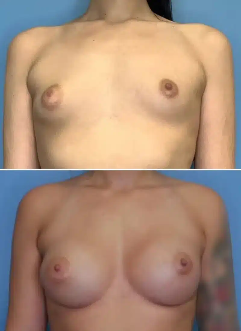Before and After Image: Breast Augmentation - front