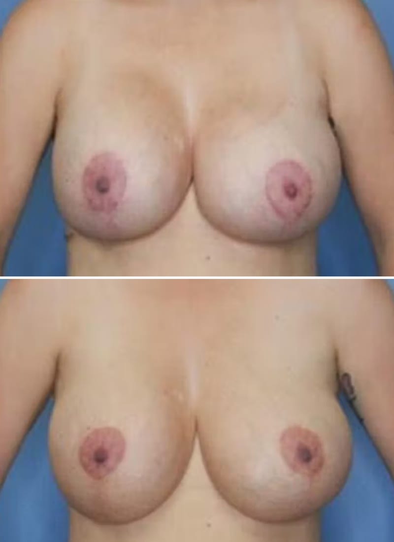 Before and After Image: Breast Augmentation - front