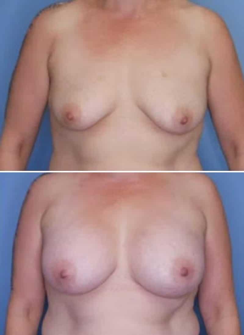 Before and After Image: Breast Augmentation - front