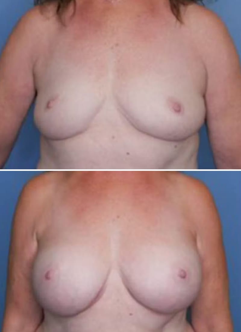 Before and After Image: Breast Augmentation - front