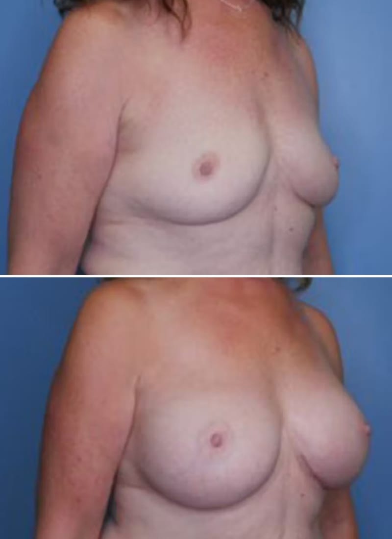 Before and After Image: Breast Augmentation - right-front-oblique