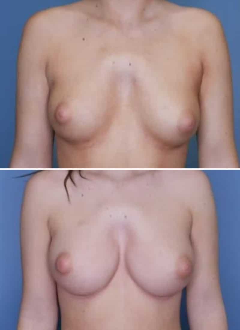 Before and After Image: Breast Augmentation - front