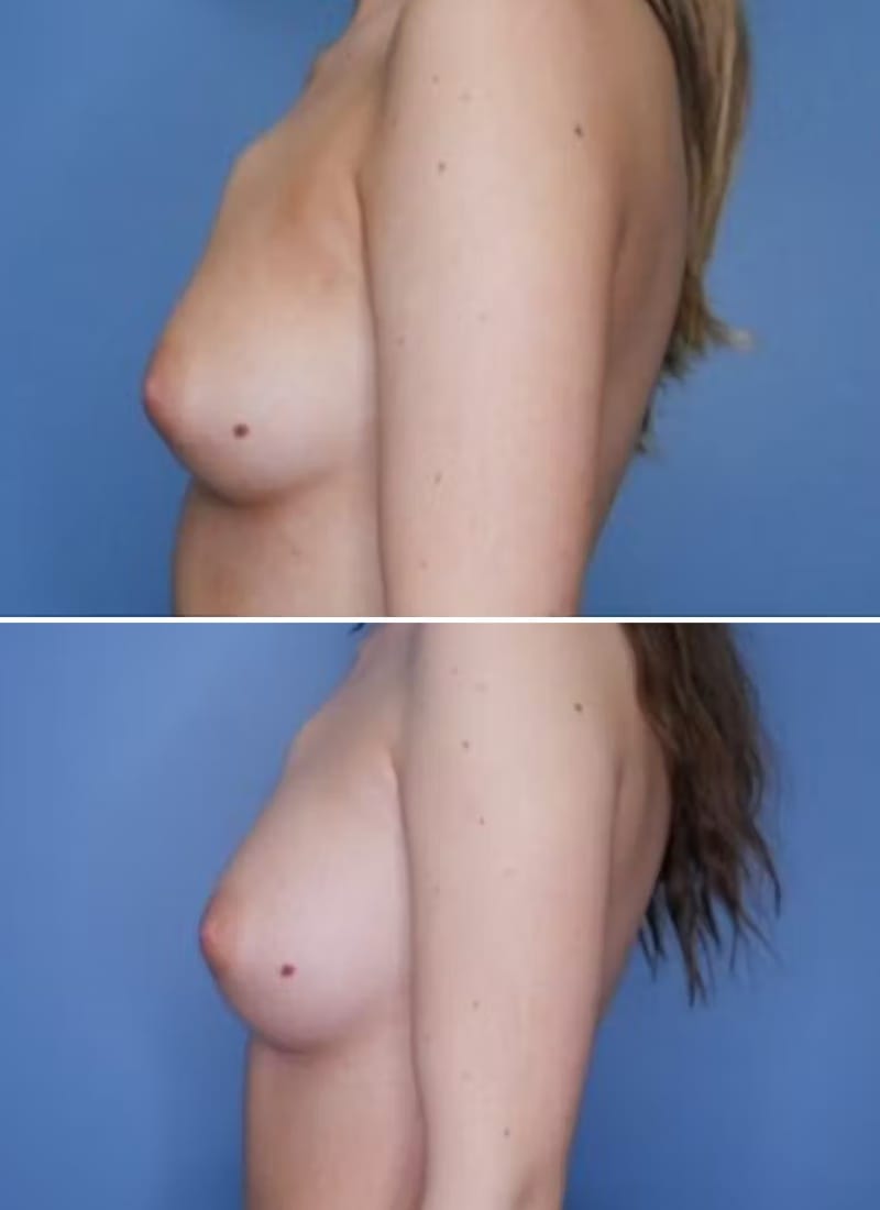 Before and After Image: Breast Augmentation - left-side
