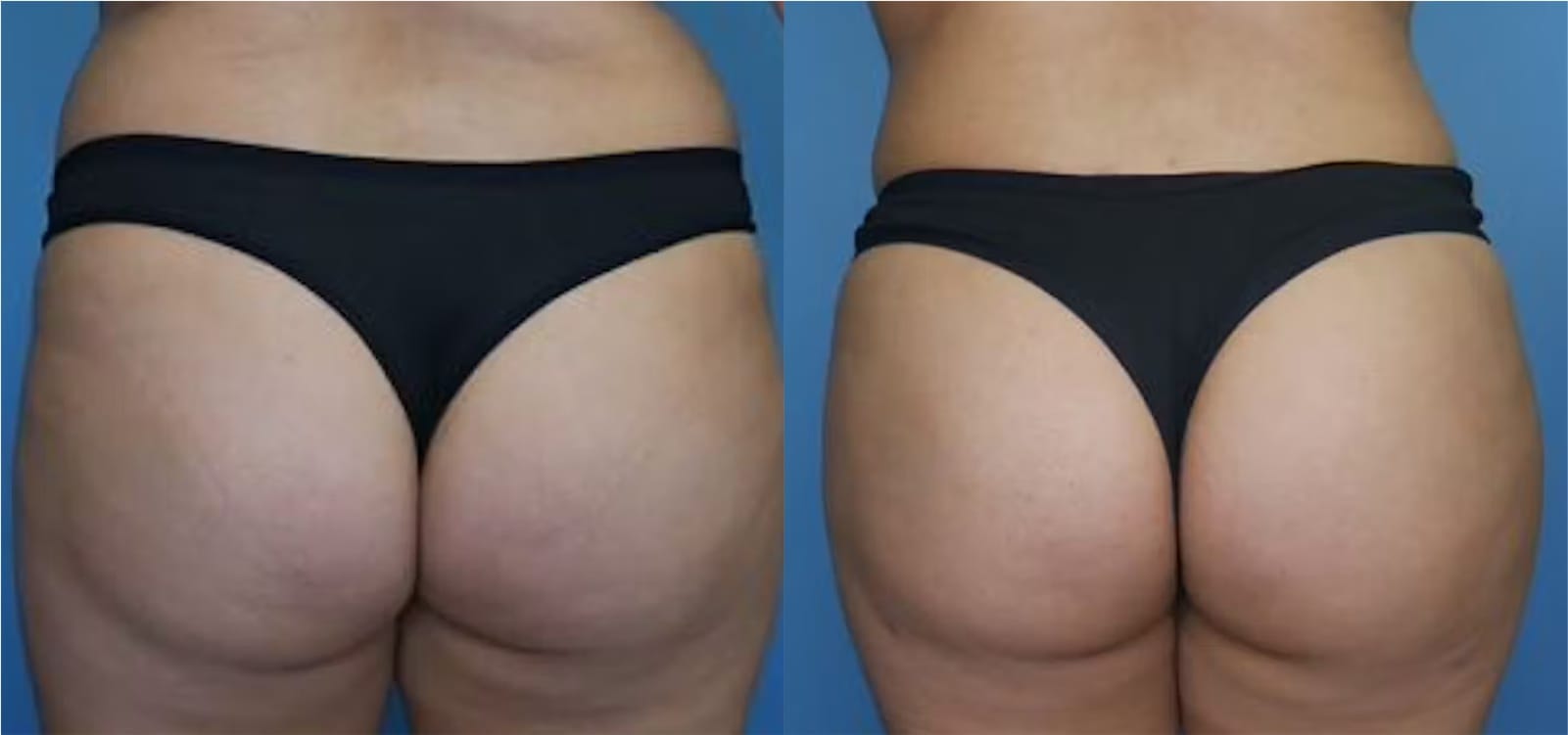 Before and After Image: BBL (Brazilian Butt Lift) - back