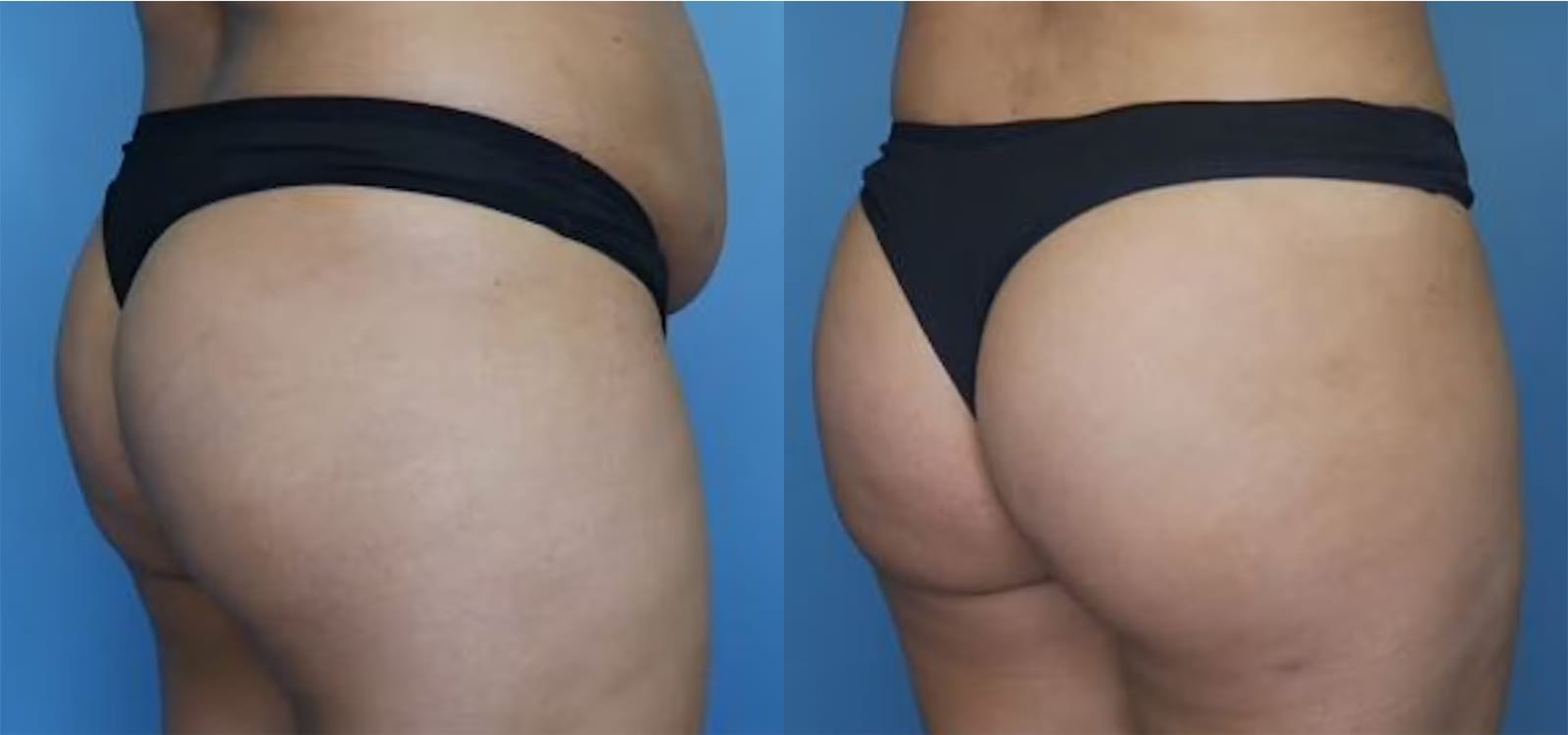 Before and After Image: BBL (Brazilian Butt Lift) - back