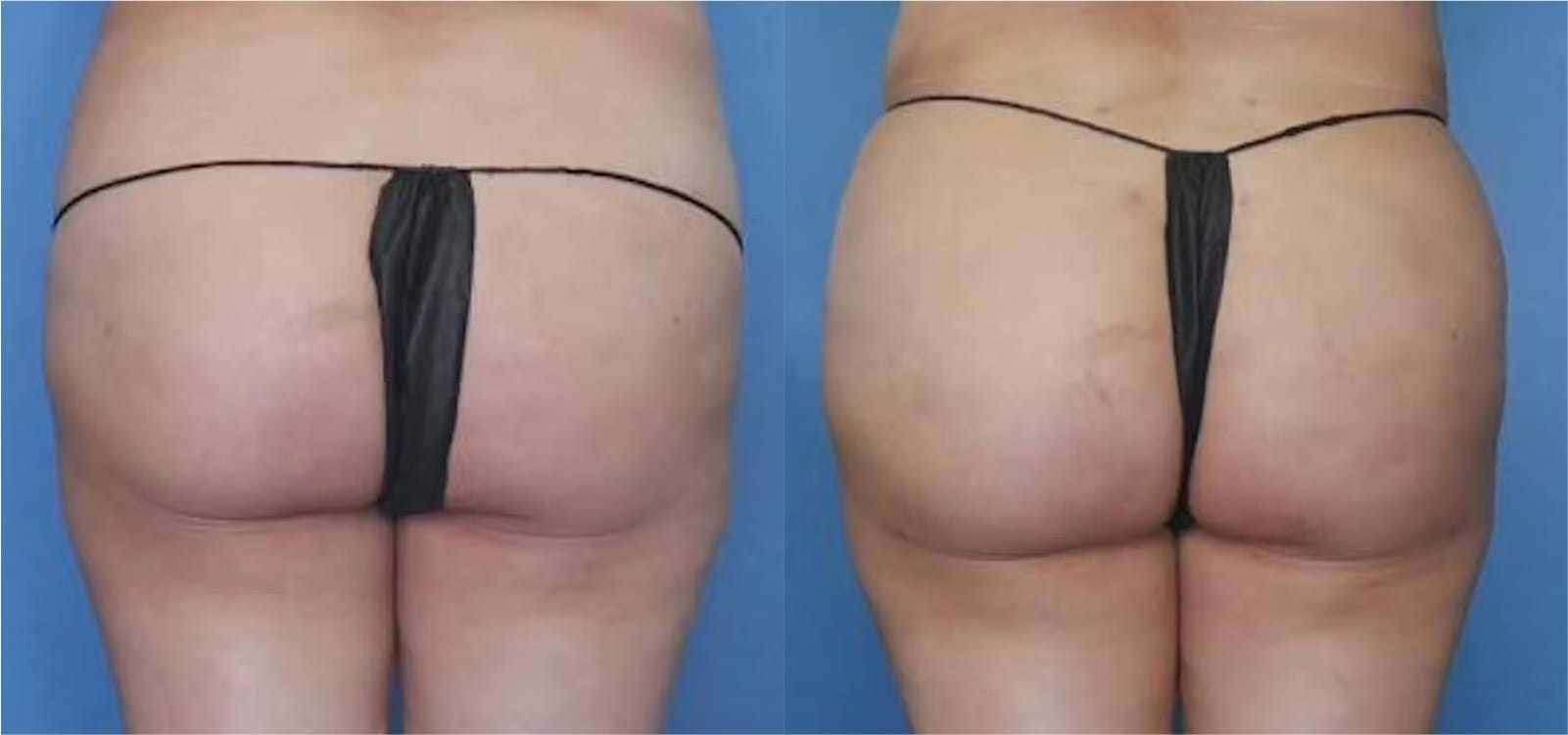 Before and After Image: BBL (Brazilian Butt Lift) - back