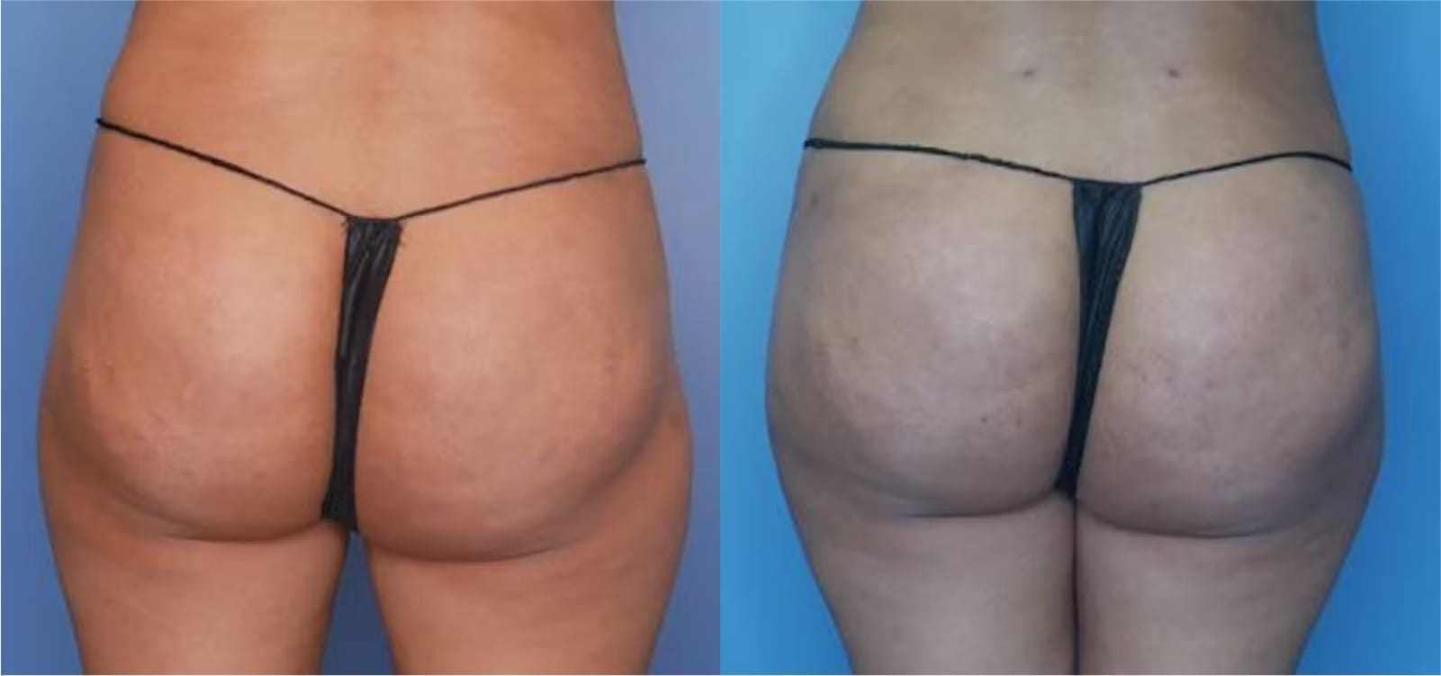 Before and After Image: BBL (Brazilian Butt Lift) - back