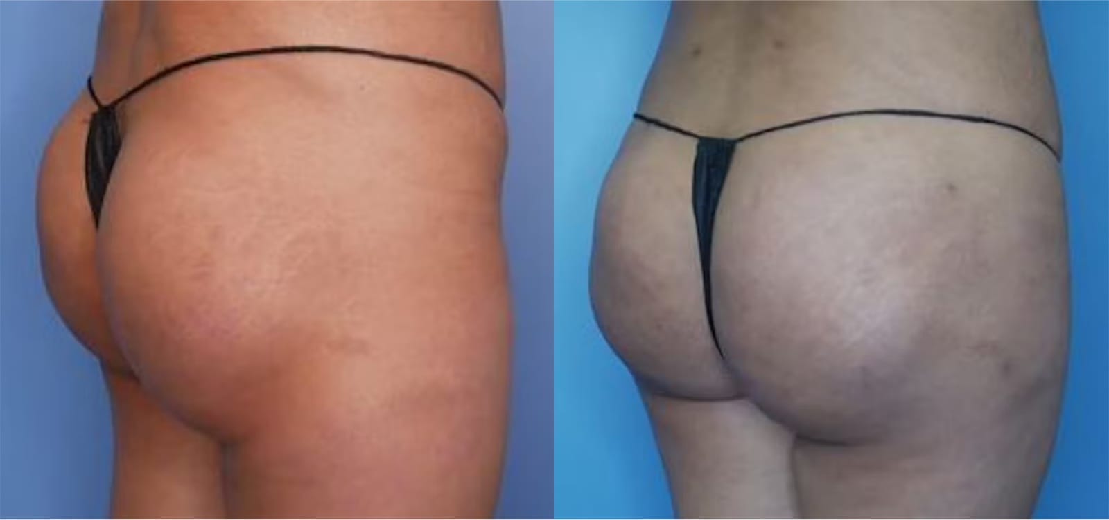 Before and After Image: BBL (Brazilian Butt Lift) - right-back-oblique