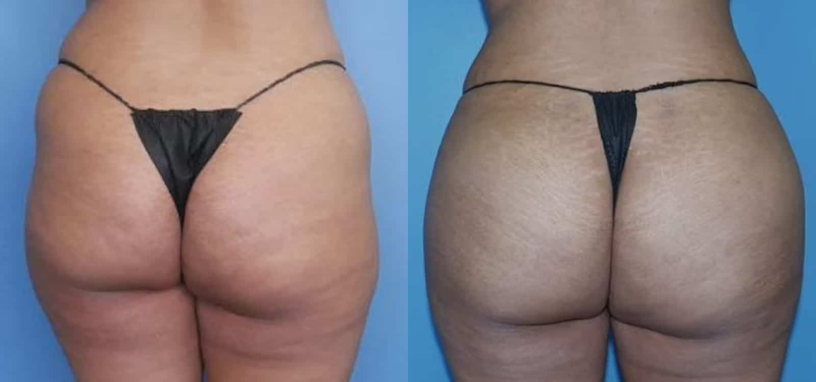 Before and After Image: BBL (Brazilian Butt Lift) - back