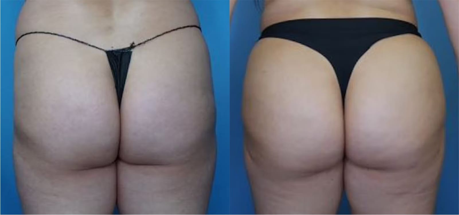 Before and After Image: BBL (Brazilian Butt Lift) - back