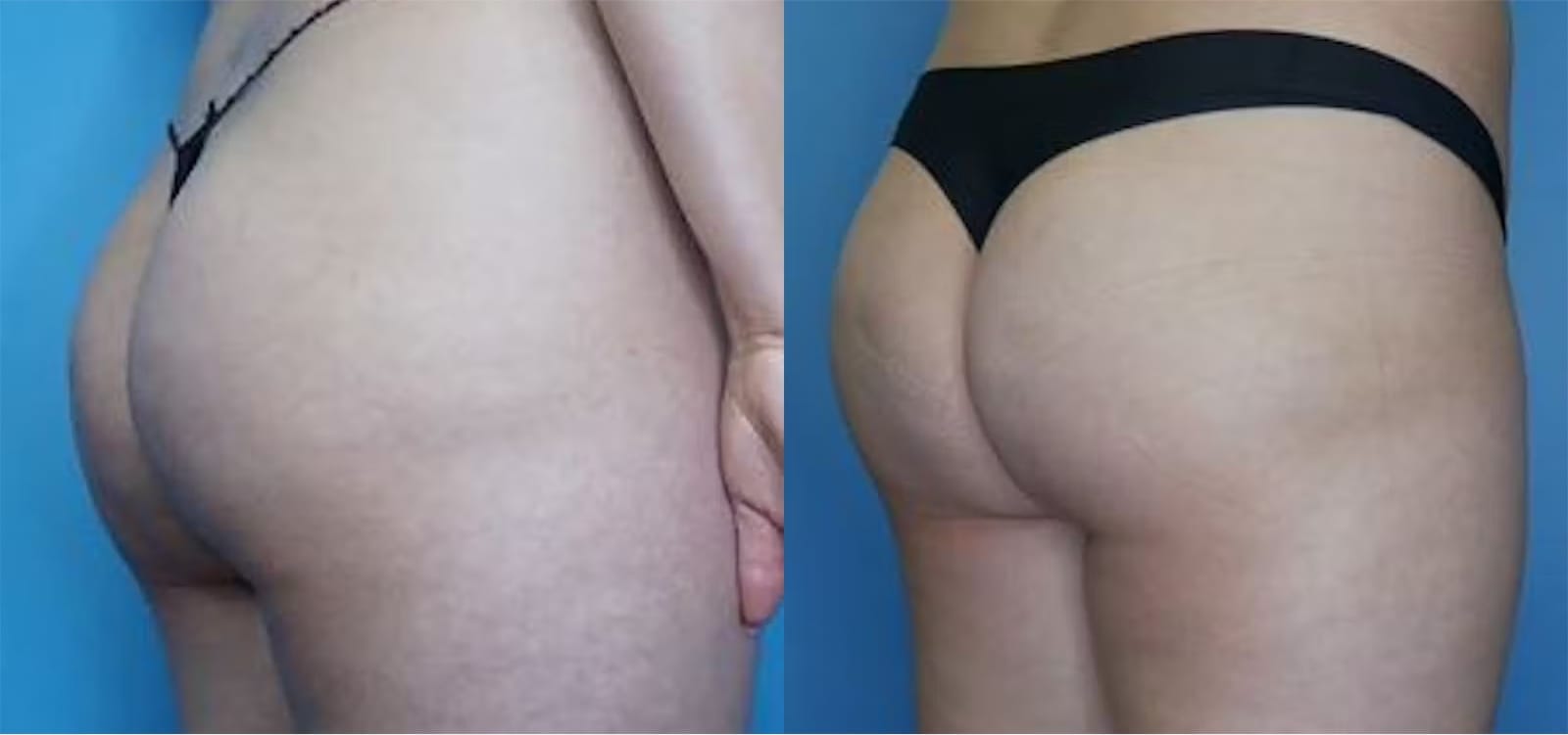 Before and After Image: BBL (Brazilian Butt Lift) - right-back-oblique