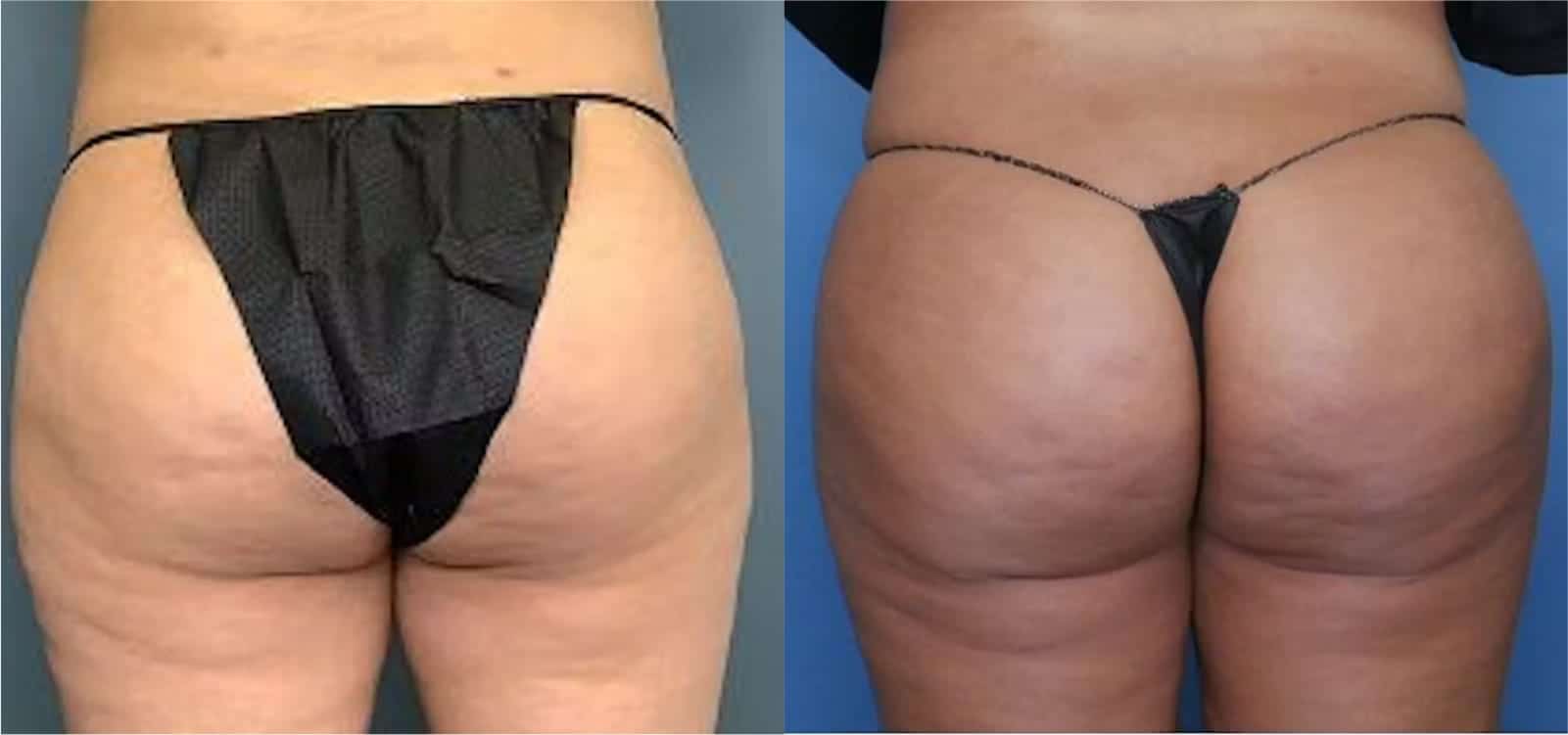 Before and After Image: BBL (Brazilian Butt Lift) - back