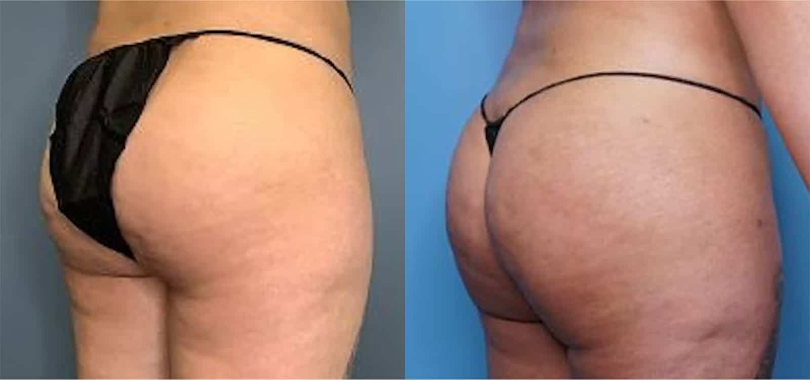 Before and After Image: BBL (Brazilian Butt Lift) - back
