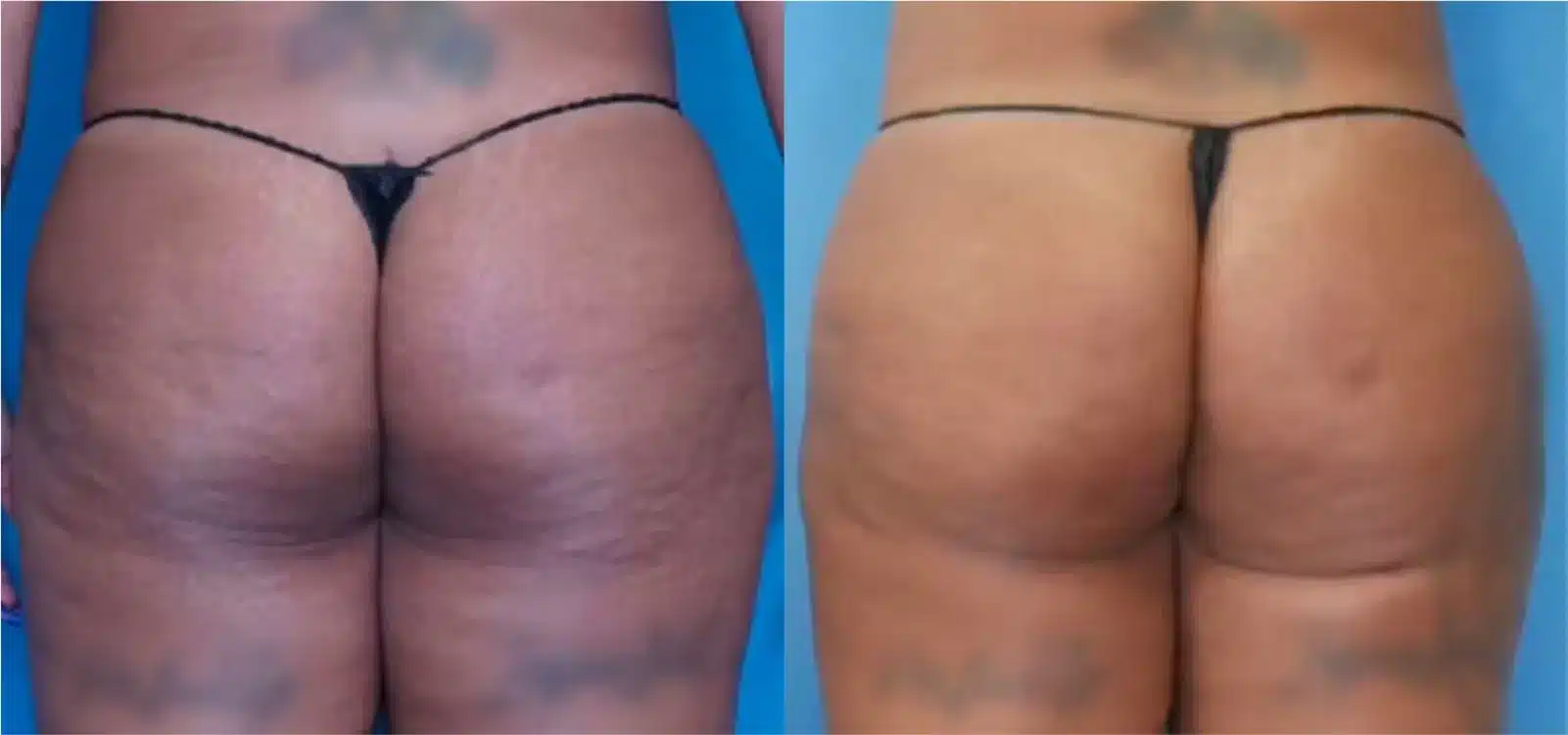 Before and After Image: BBL (Brazilian Butt Lift) - front
