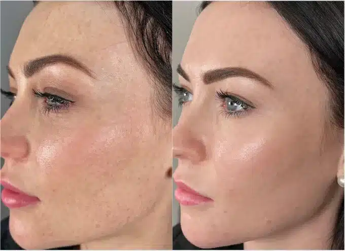 Before and After Image: Moxi Laser - left-front-oblique