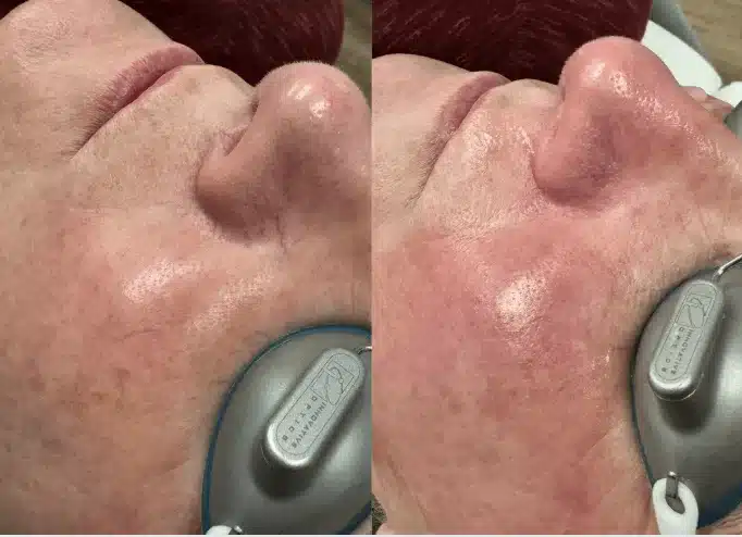 Before and After Image: BBL (Broadband Light) - left-side