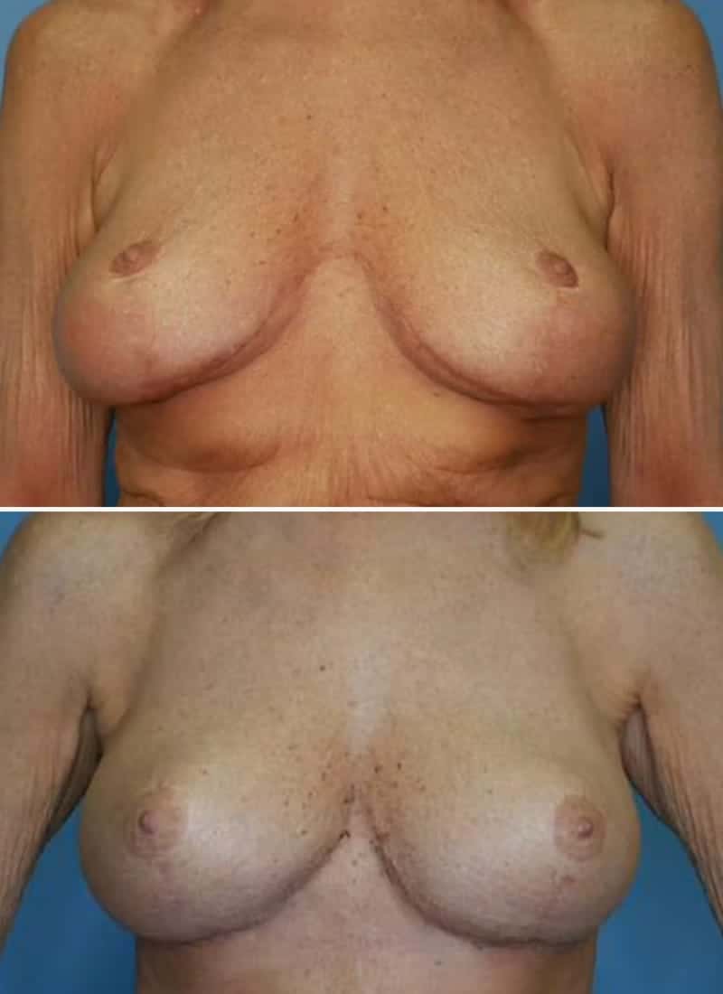 Before and After Image: Breast Lift - front