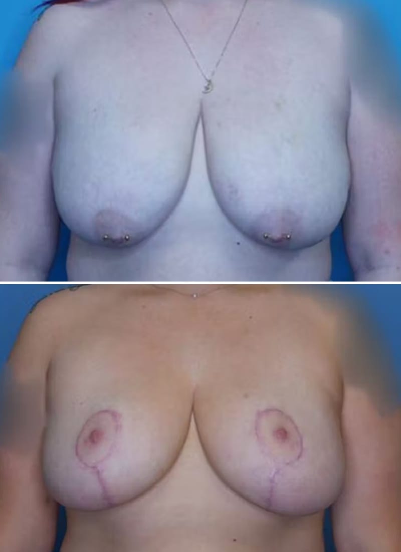Before and After Image: Breast Lift - front