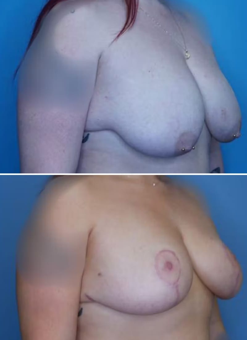 Before and After Image: Breast Lift - right-front-oblique