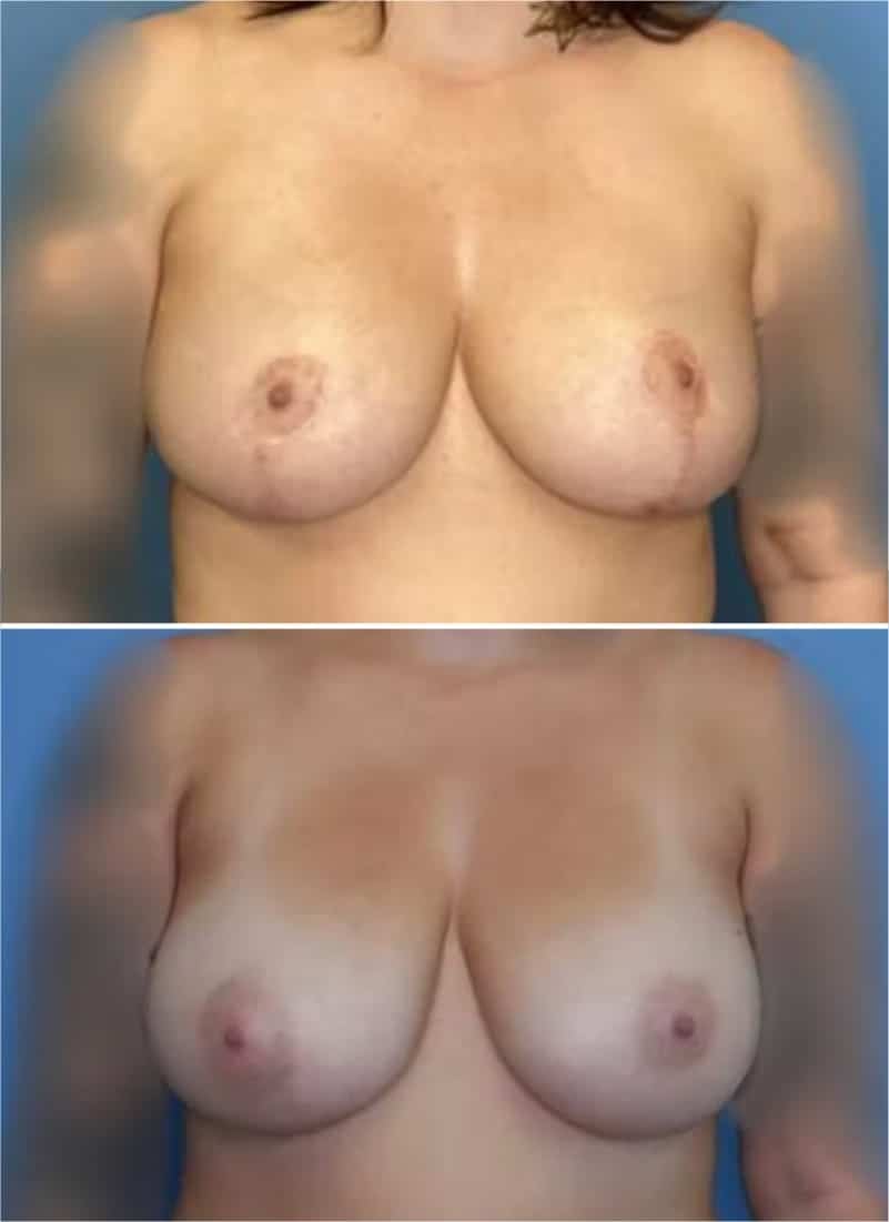Before and After Image: Breast Lift - front