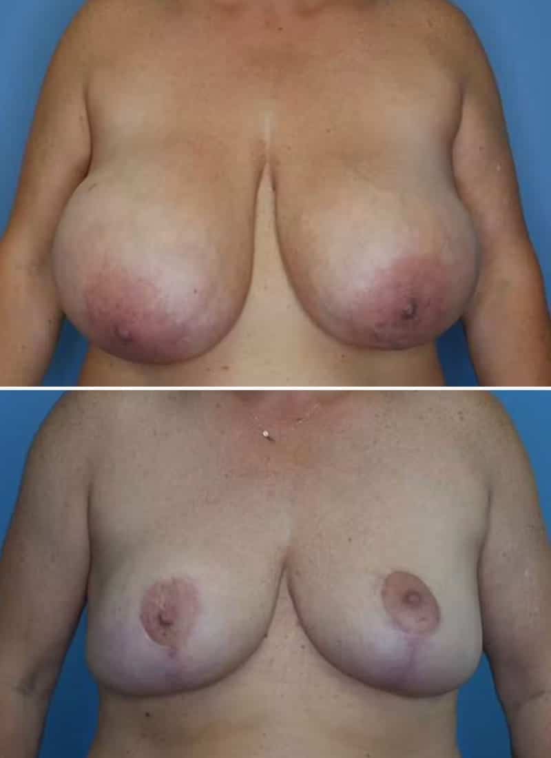 Before and After Image: Breast Lift - front