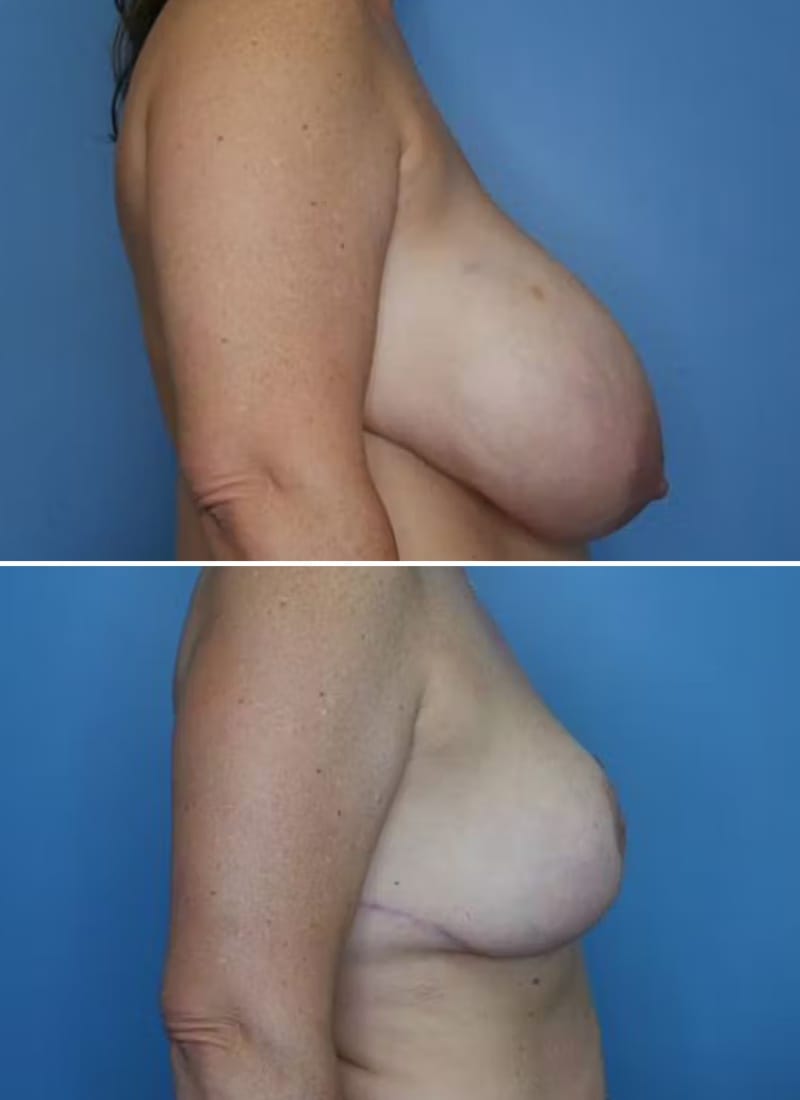 Before and After Image: Breast Lift - right-side