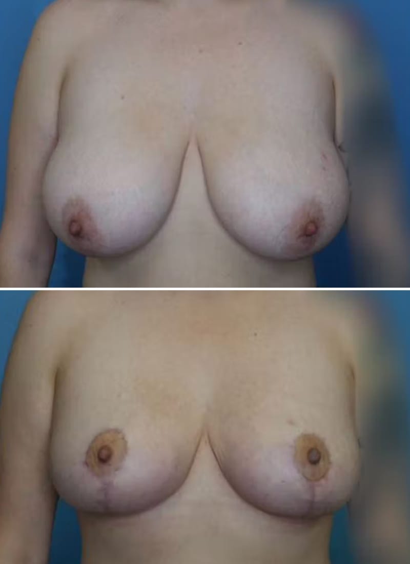 Before and After Image: Breast Lift - front